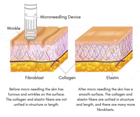 Illustration of microneedle process